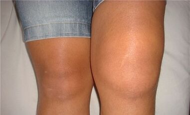 Causes of arthrosis of the knee joint