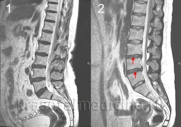 Spinal osteochondrosis