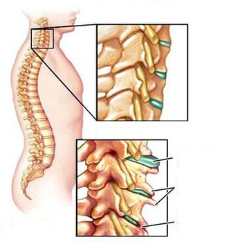 A healthy and painful comparison of the neck vertebrae