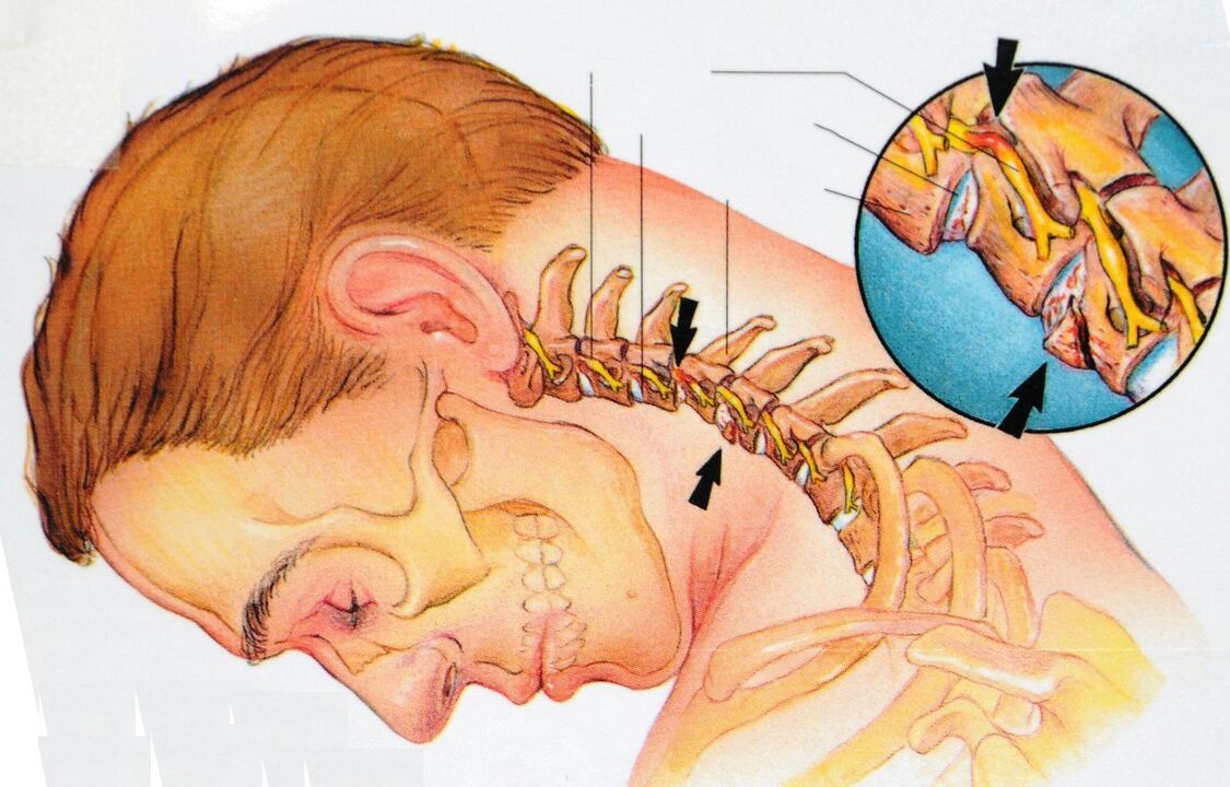 Osteochondrosis of the cervical area