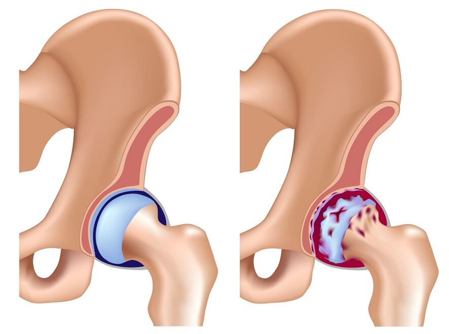 healthy joints and arthrosis of the hip joint