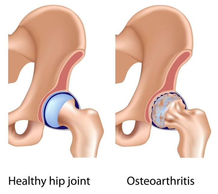 healthy joints and hip joint arthrosis
