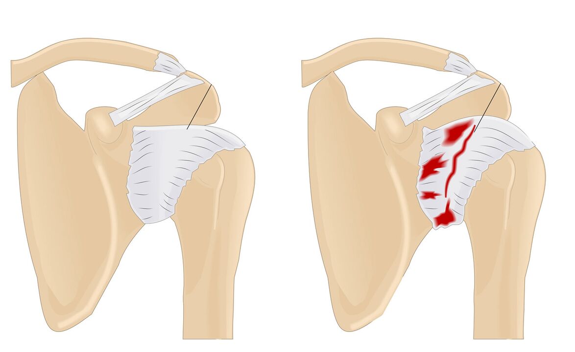 normal and affected joints